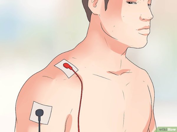 Dois eletrodos fixados em um paciente. Em: https://pt.wikihow.com/Posicionar-os-El%C3%A9trodos-de-Um-Aparelho-de-TENS#/Imagem:Place-Electrodes-for-a-Tens-Unit-Step-2-Version-2.jpg